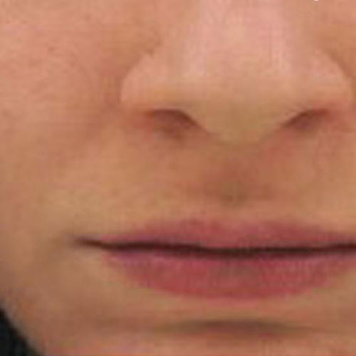 skin after chemical peel