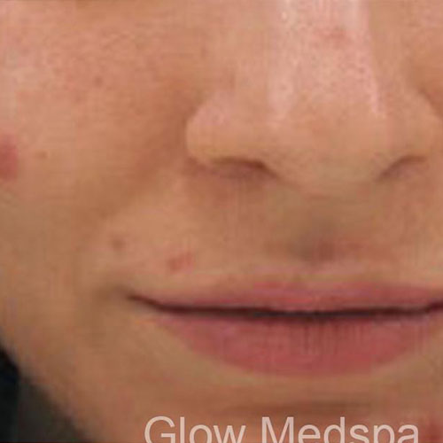 Closeup woman's face before chemical peel procedure