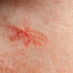 Closeup of redness on skin