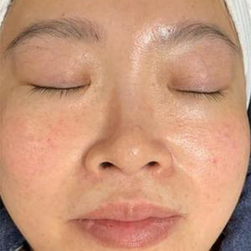 a closed eyes woman undergoing aqua facial