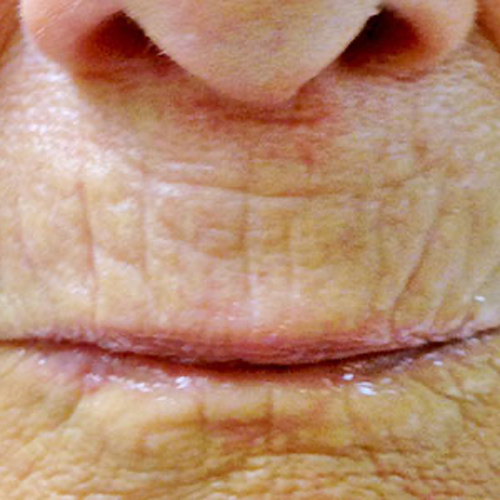 After microneedling