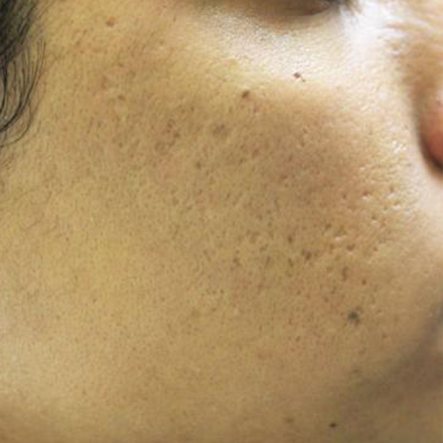 check with acne scar