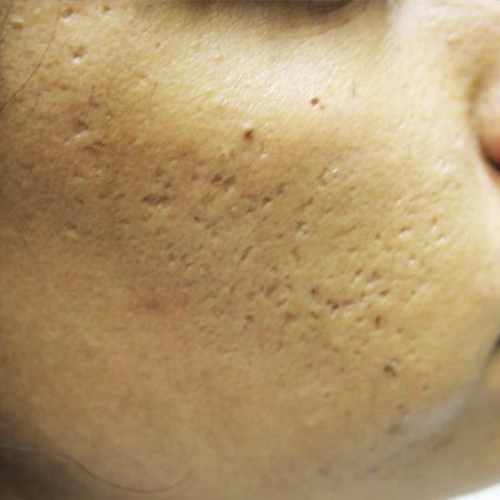 close up photo of an acne scar