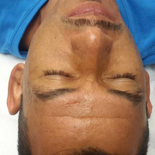 a man closed eyes preparing for microneedling