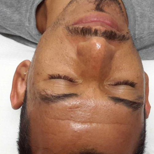 A man preparing for laser hair removal beard