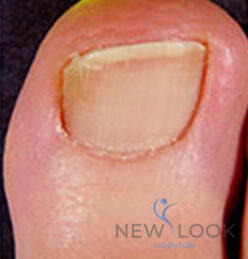 Damaged toenail
