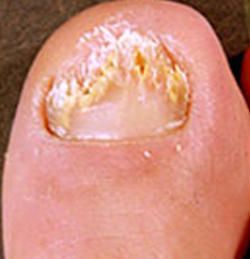 Toenail with fungus