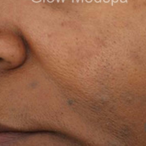 photo of skin in the face with acne
