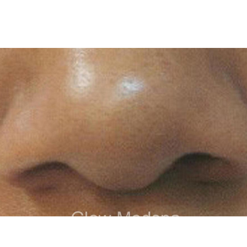 After peeling and cleansing the face