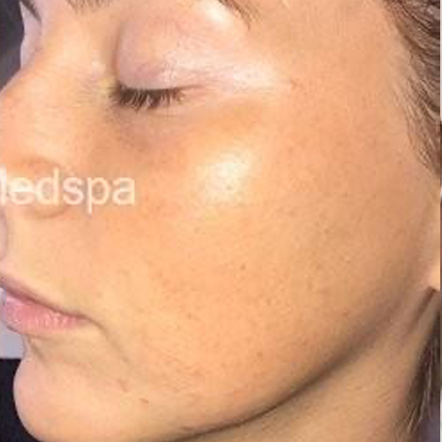 Side profile of a woman after a dermaplaning procedure