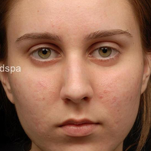 A photo of a woman after dermaplaning.