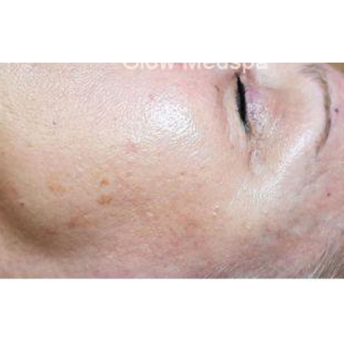 after dermaplaning care