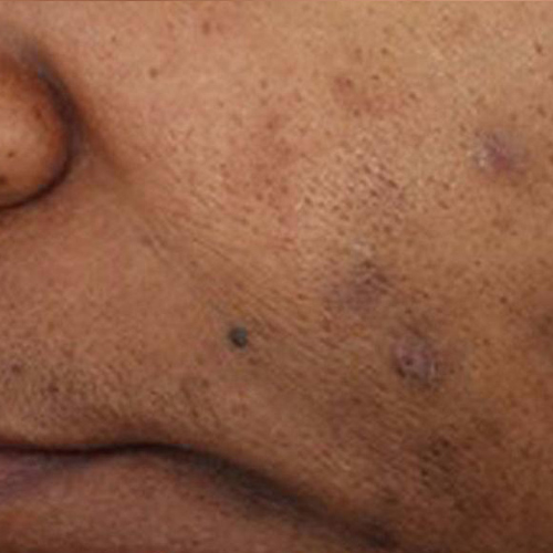 Photo of a man's face with acne