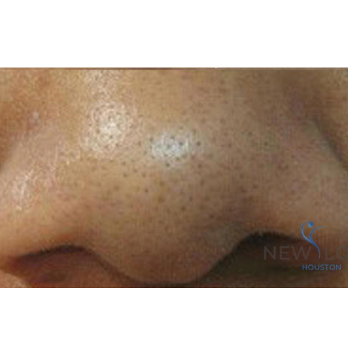 Enlarged pores on the face.