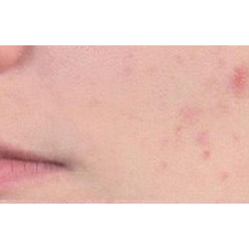 acne on face
