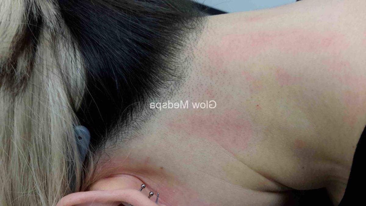 A woman is lying face down, getting ready for the procedure of laser hair removal of the neck.