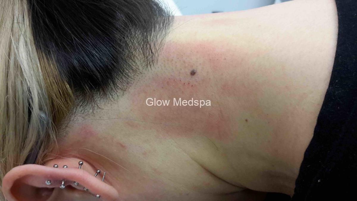 A woman is lying face down, getting ready for the procedure of laser hair removal of the neck.