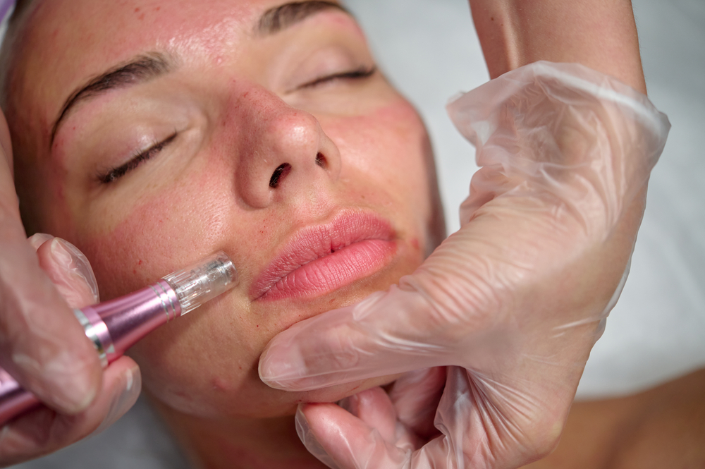 a woman having microneedling in a reputable microneedling clinic in texas