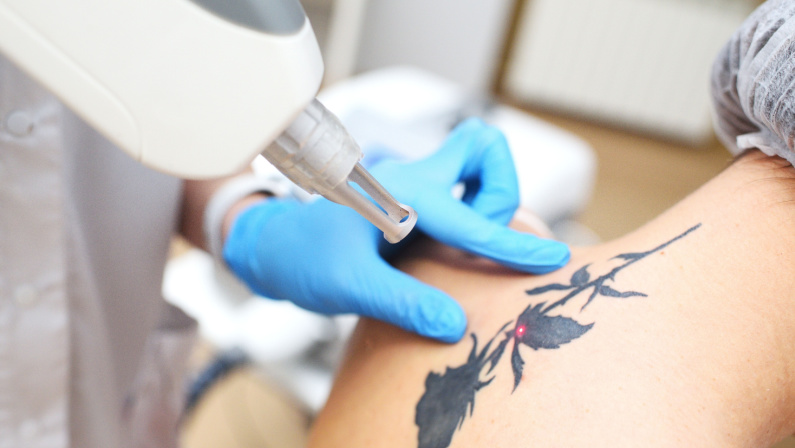 the cosmetologist removes the tattoo to the patient using a neodymium laser in a modern clinic. Hardware cosmetology